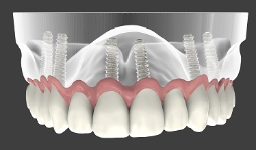 İmplant Tedavisi Sonrası Nelere Dikkat Edelim!..